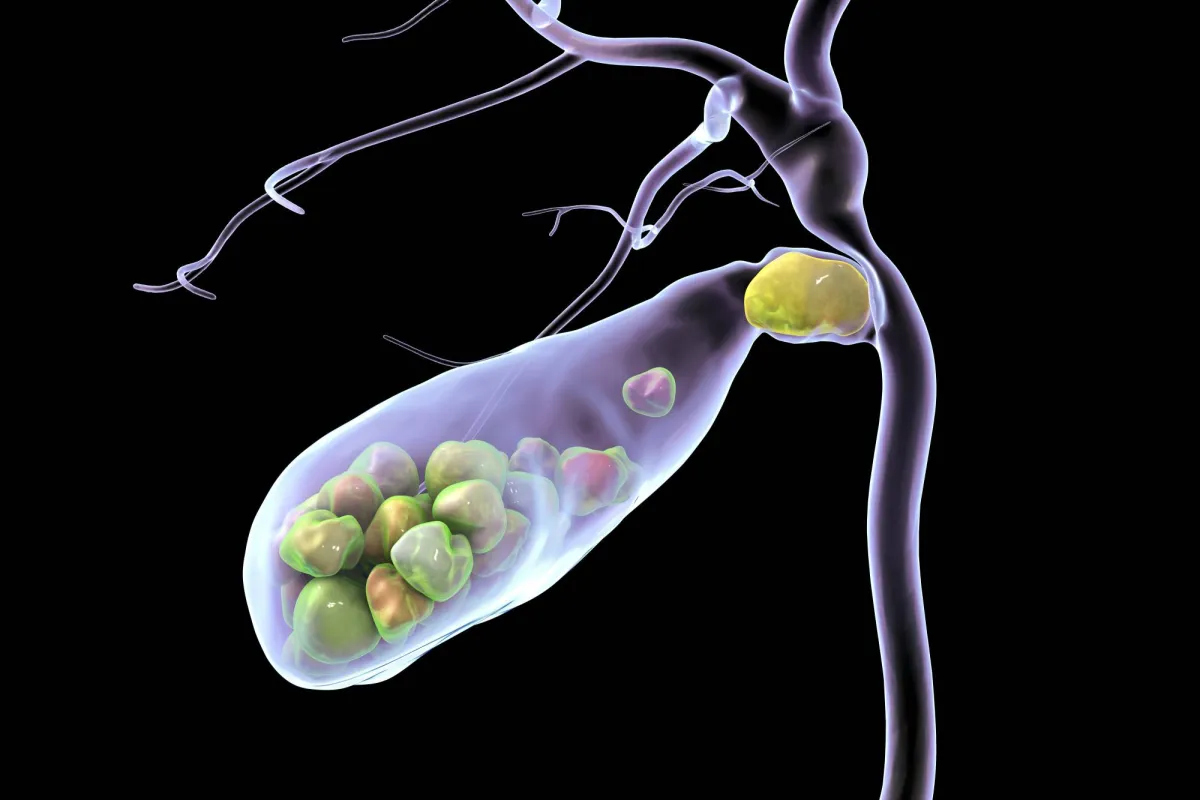 حصى المرارة... كيف تتكون وما طرق تشخيصها